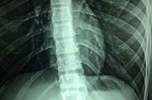 Spinal Cord Injury attorney